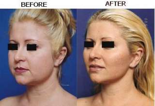 Face Thin Device   Lose Weight Face Fat Fast   Proven!  